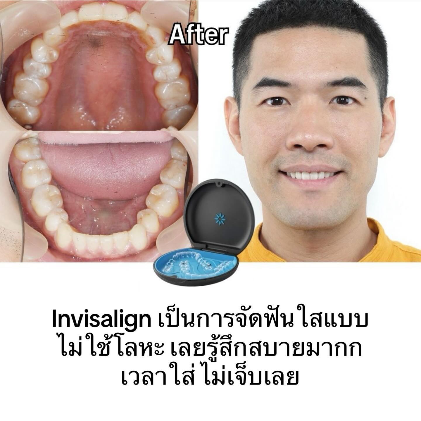 วู้ดดี้ - วุฒิธร มิลินทจินดา